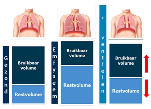 Verschil in restvolume tussen gezonde longen, longen met emfyseem en longen na behandeling met ventielen